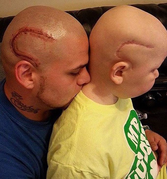 Brain tumor