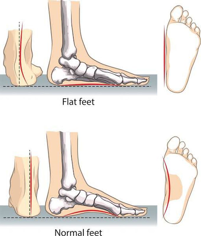 Flat feet