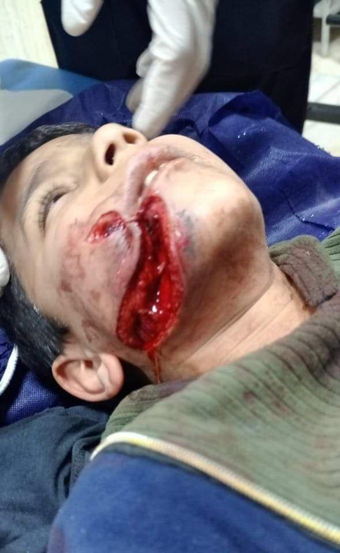 A 10 years old boy, throw a can of pesticidel on the fire. when he was near from it .. it's exploded on his face. 😔(1)
