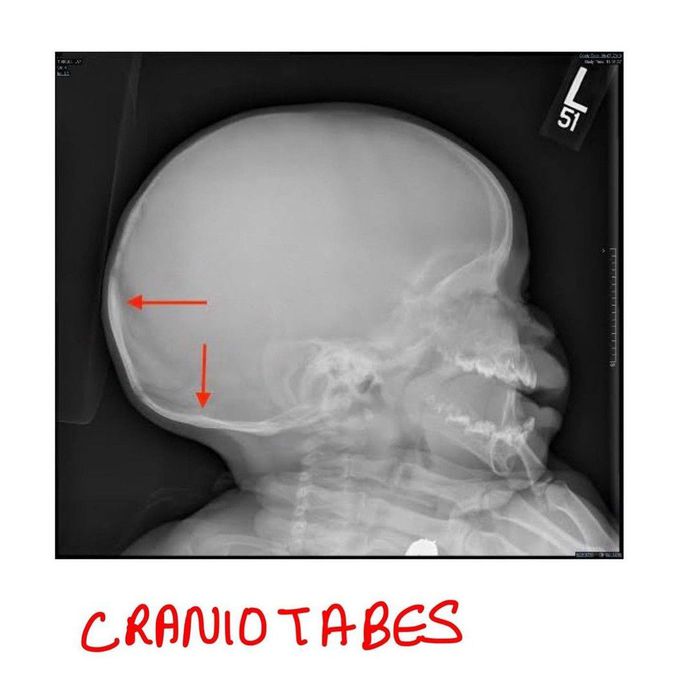 CranioTabes