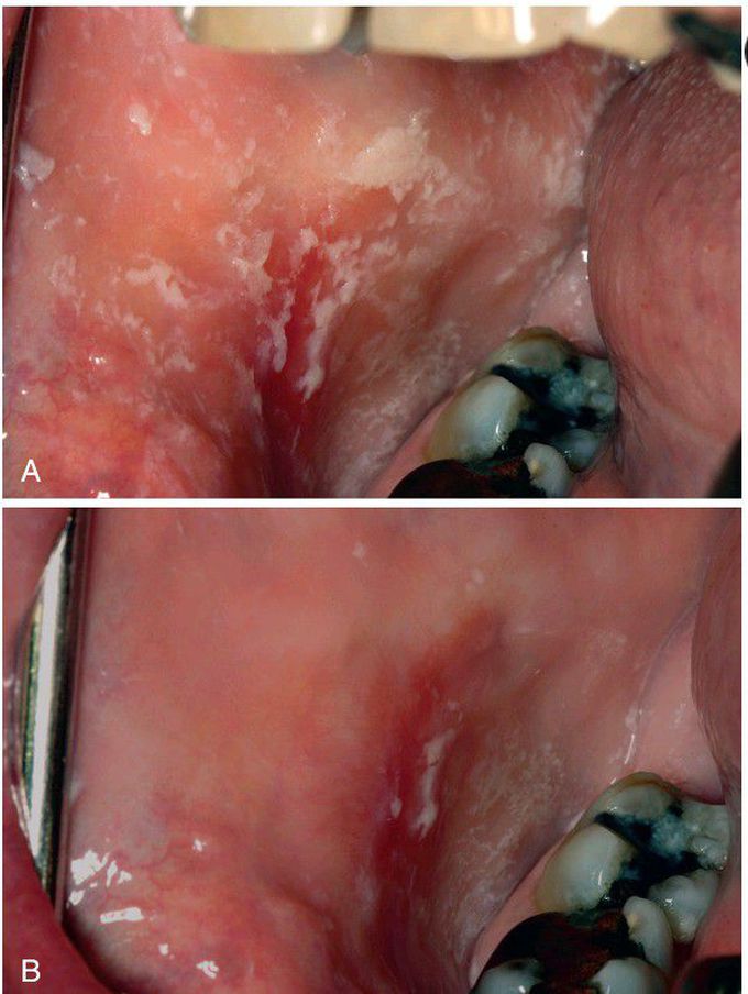 Pseudomembranous Candidiasis