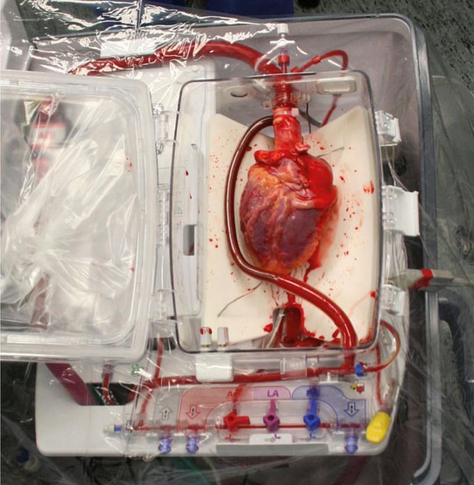 Donor heart before transplant