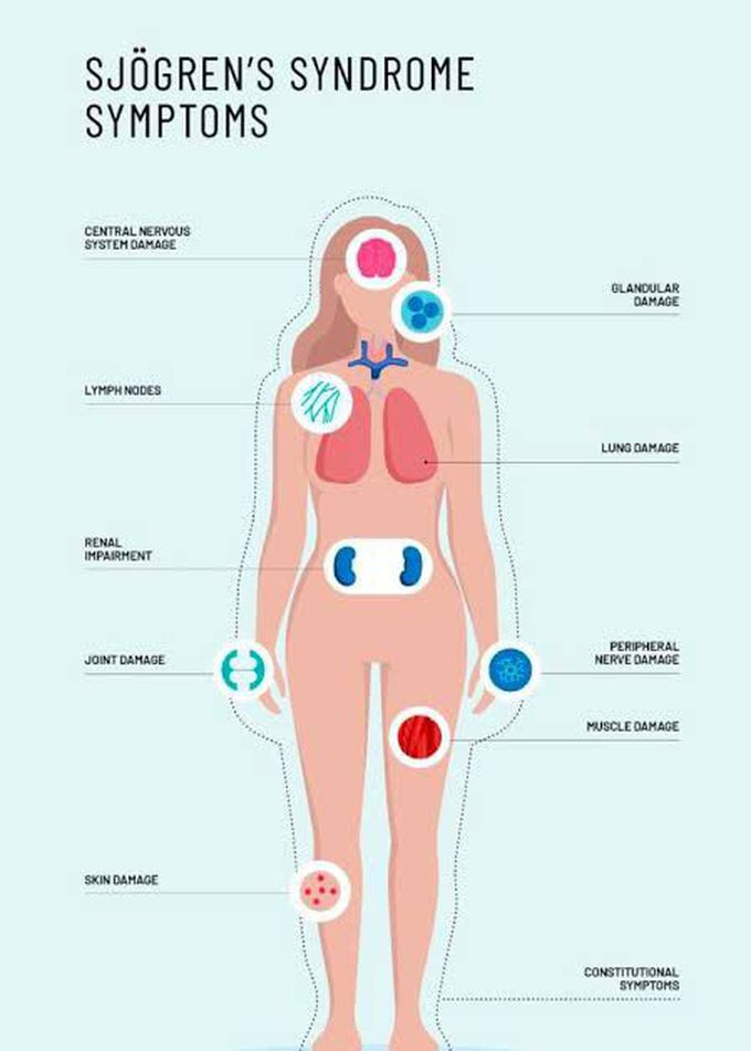 These are the symptoms Sjogrens syndrome