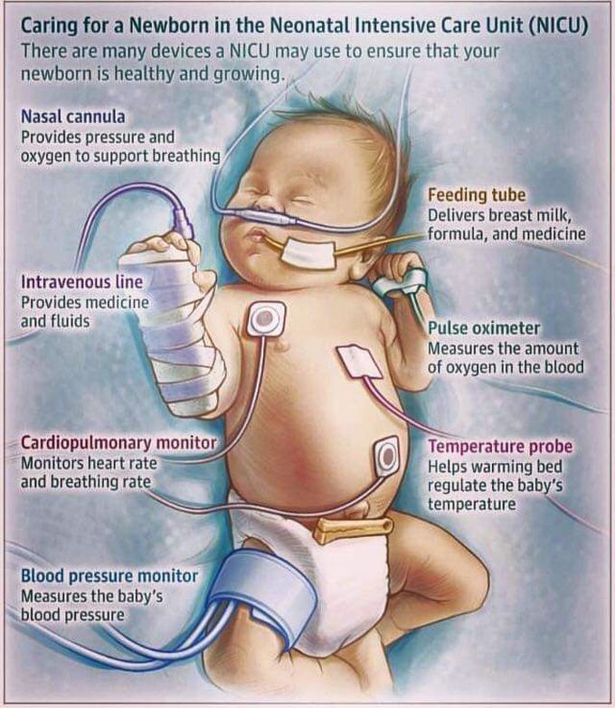 Caring of new born babies in the NICU