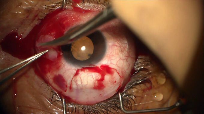 6 Minute Ptergyium Surgery