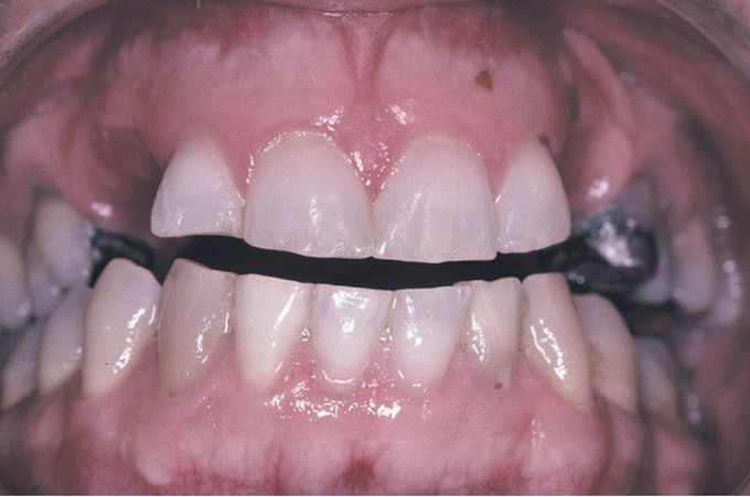 Dentin Dysplasia Type I (DD-I).