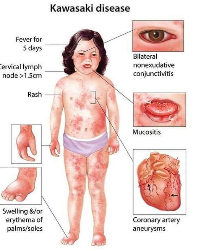 Kawasaki Disease-II