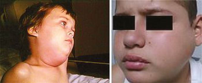 Causes of Parotitis