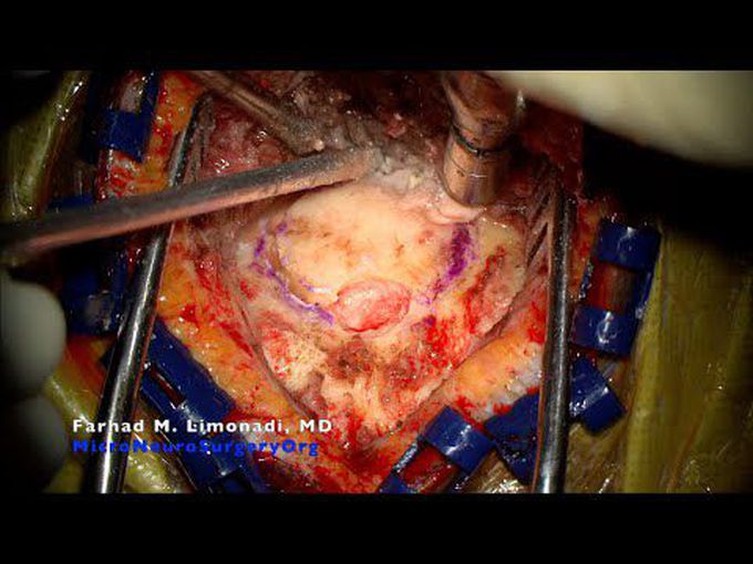 Surgical management of hemorrhagic Stroke (cerebellar hemorrhage).  Suboccipital craniotomy.