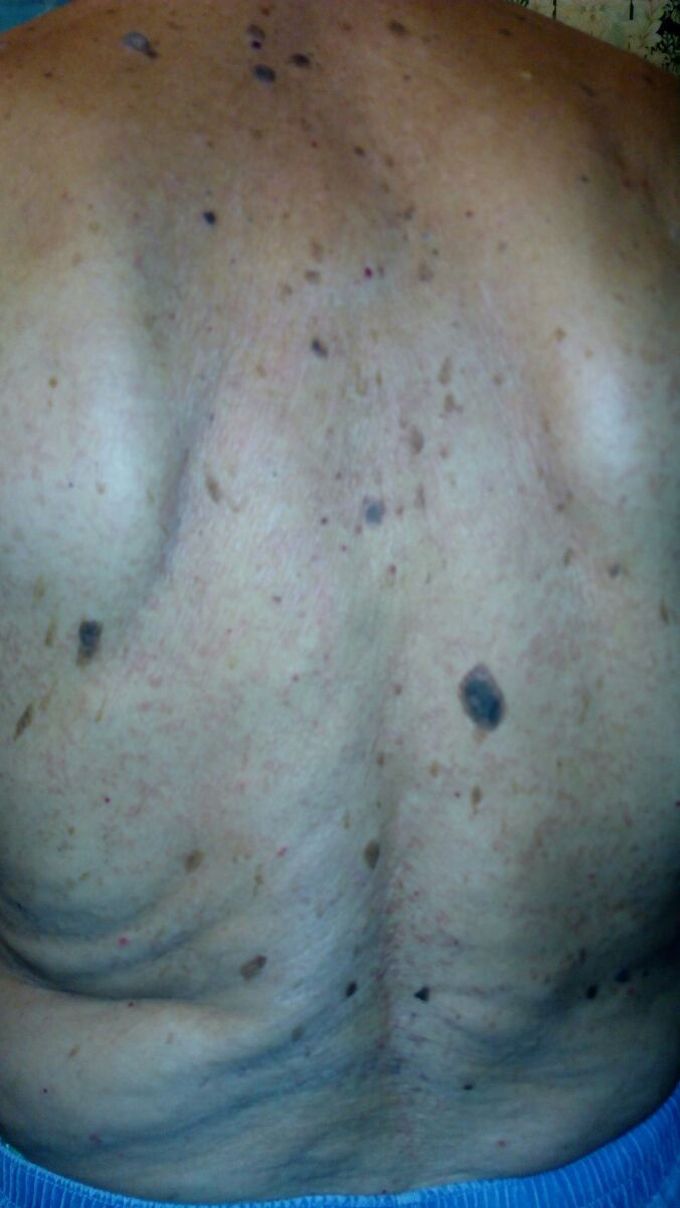The patient is 80 years old, within 3 days there was a painful rash on his back. I suspect herpes zoster?