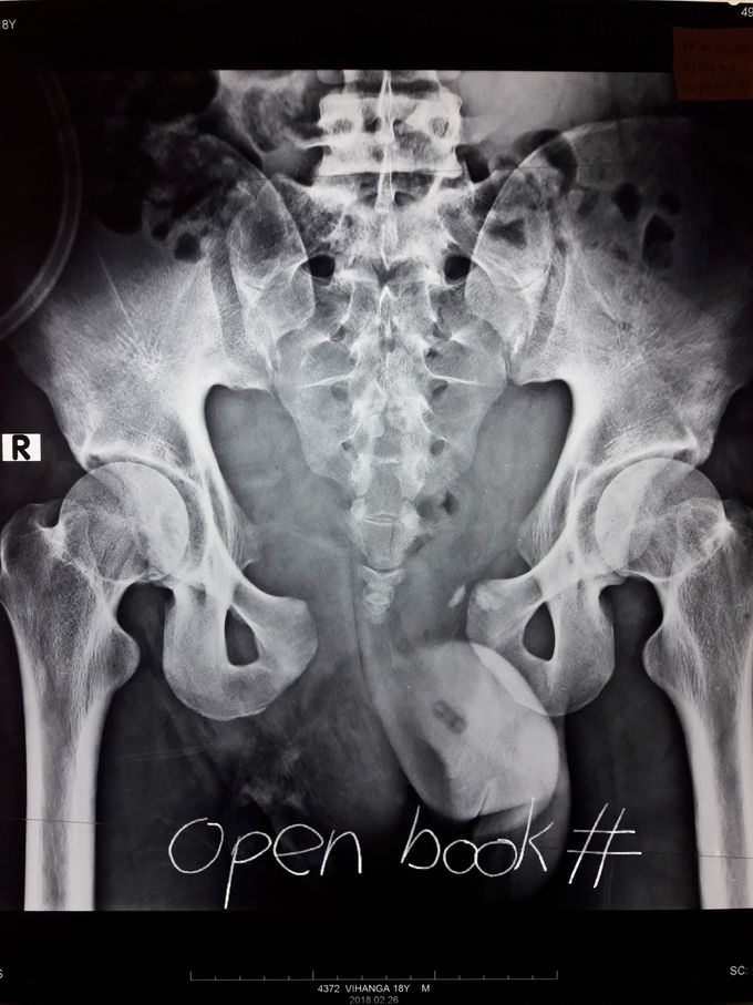 What are open book pelvic fractures?