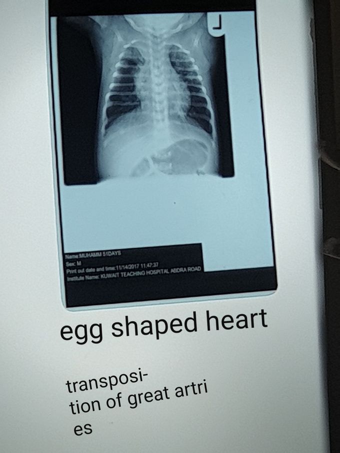 Transposition of greater arteries