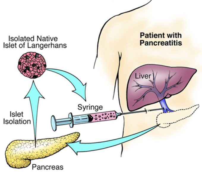 Treatment of Pancreatic divisum