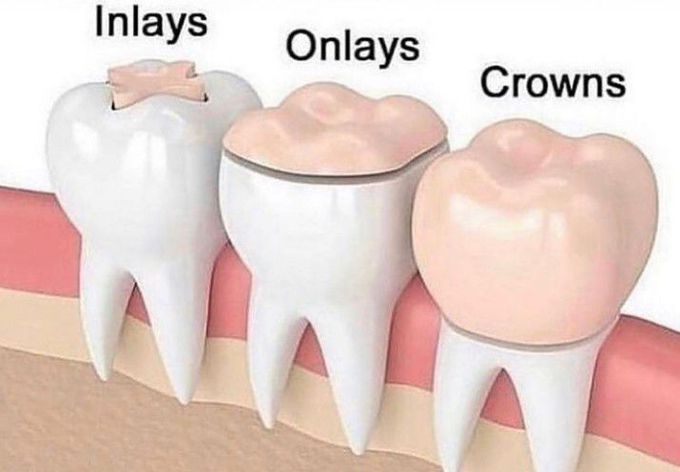 Inlay, onlay and crown