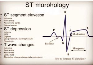 ST morphology - MEDizzy