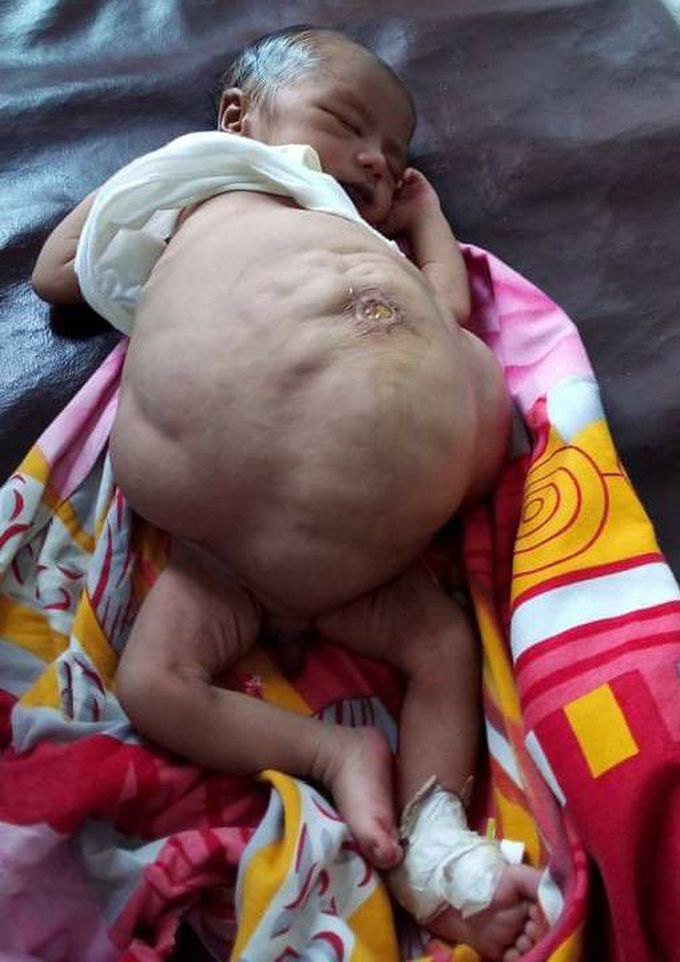Prune Belly Syndrome in Children