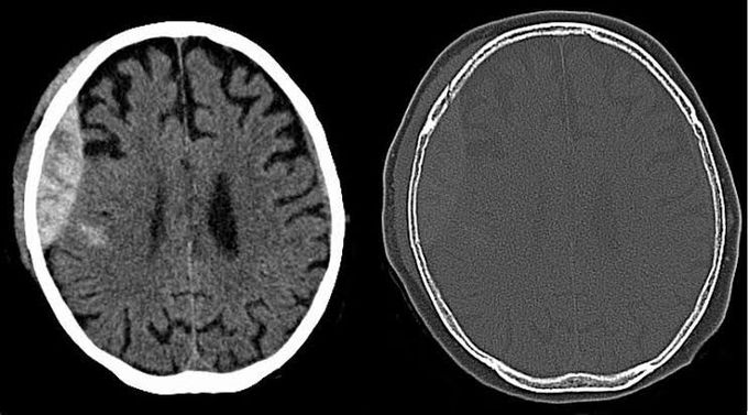 Extradural hematoma