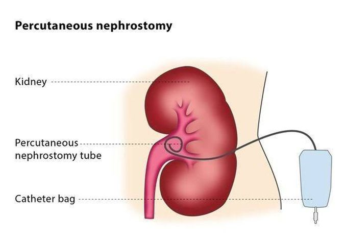 Nephrostomy