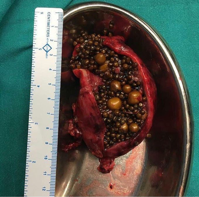 Gallstones