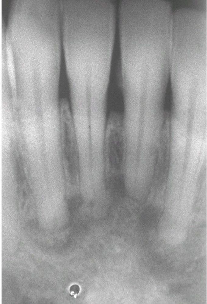 Periapical Cemento-Osseous Dysplasia.