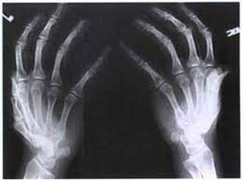 X Ray Hand Ap Lat