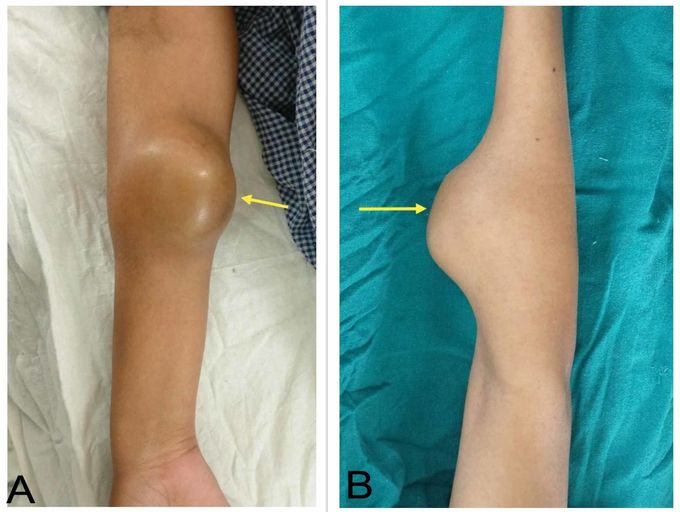 Ewing sarcoma