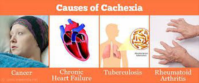 Causes of cachexia ( wasting syndrome)
