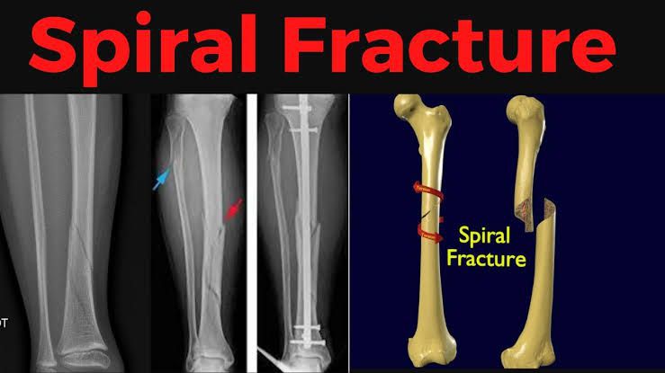 Spiral Fracture MEDizzy