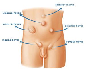 Femoral hernia by fbgchbnmgj - Issuu