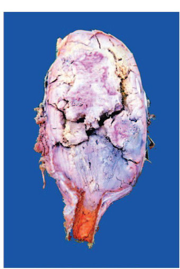 Giant cell tumour