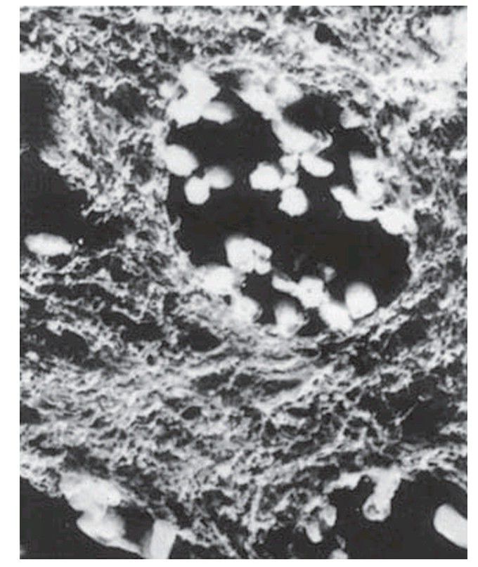 Infection of the dentinal tubules