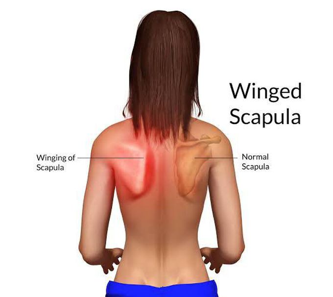 Winged scapula