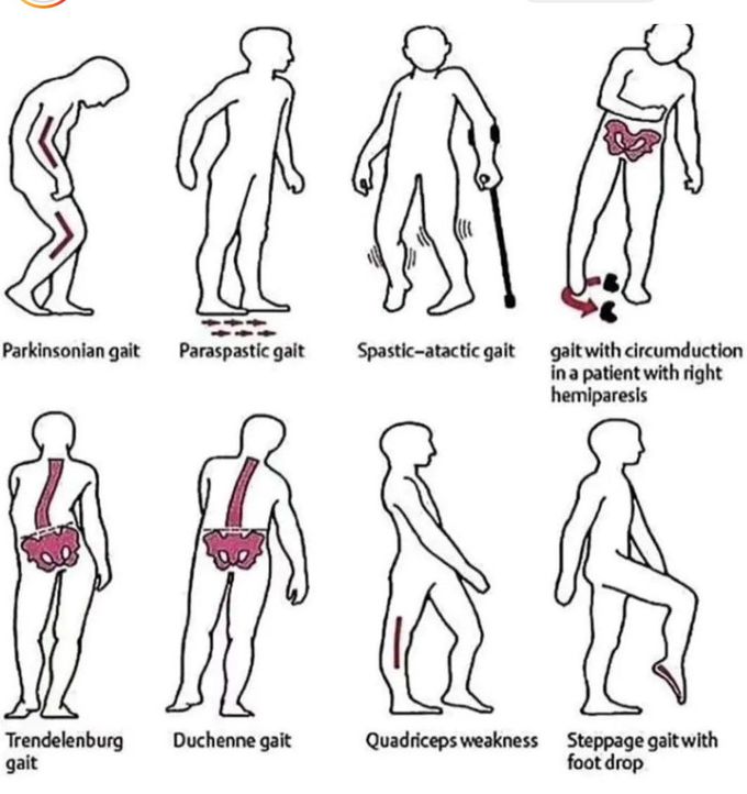 Pathological Gait