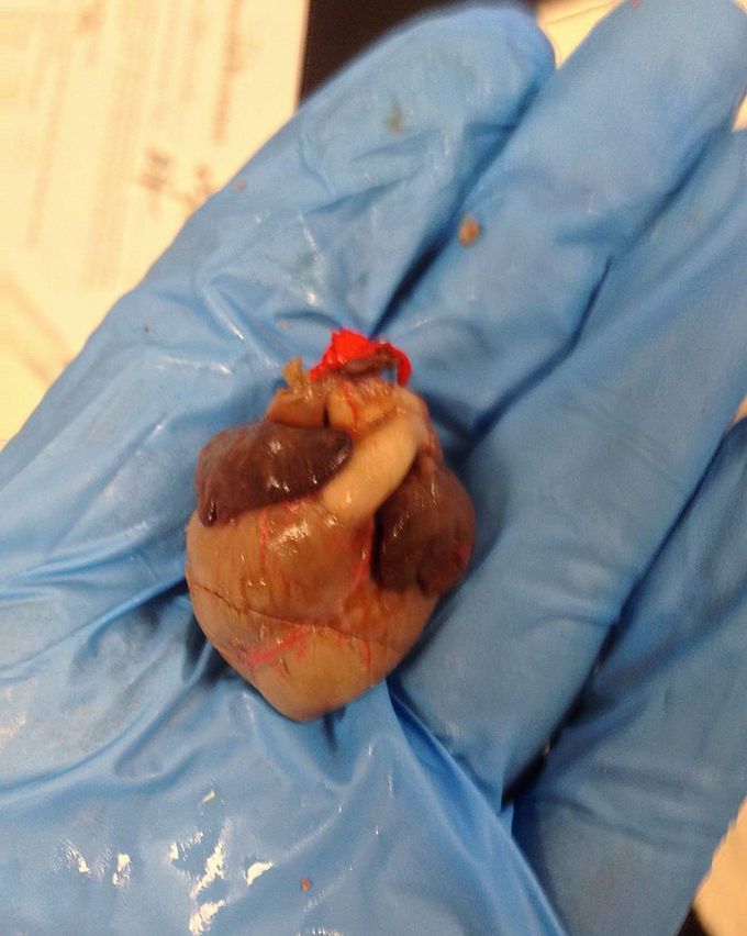 Fetal heart
