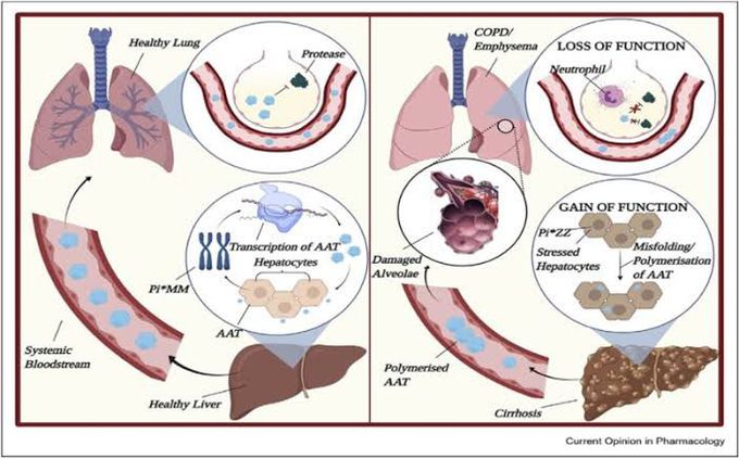 Alpha-1 anti-tyrpsin deficiency pathogenesis