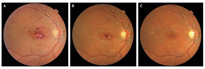 Roth Spots in Infective Endocarditis