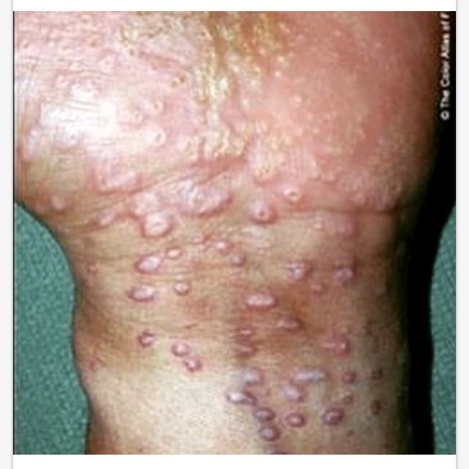 Molluscum contagiosum