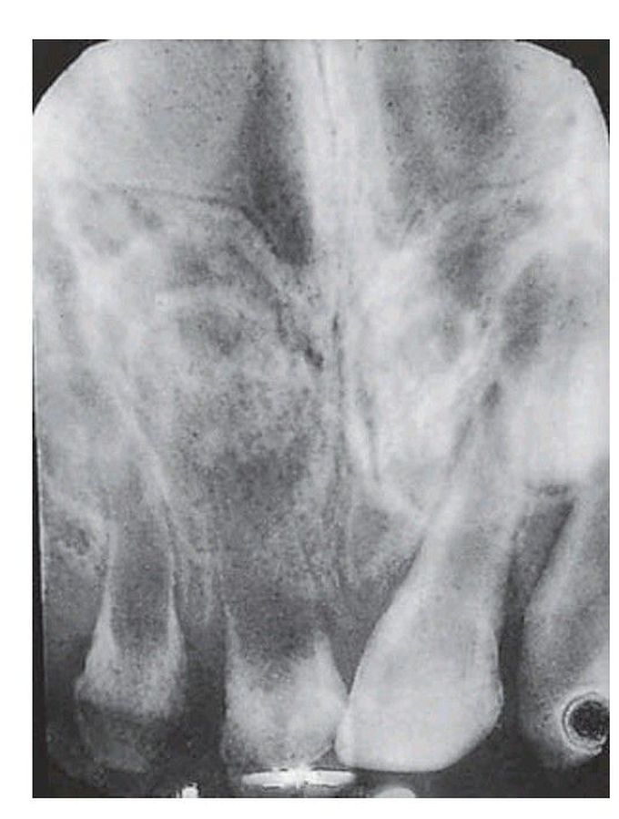 Radiographic appearance of regional odontodysplasia.