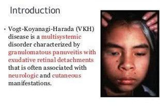 Vogt- koyanagi syndrome