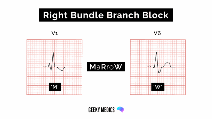 Right Bundle Branch Block