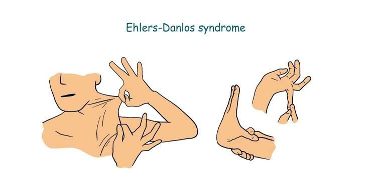 Ehler Danlos Syndrome Symptoms Medizzy 9515