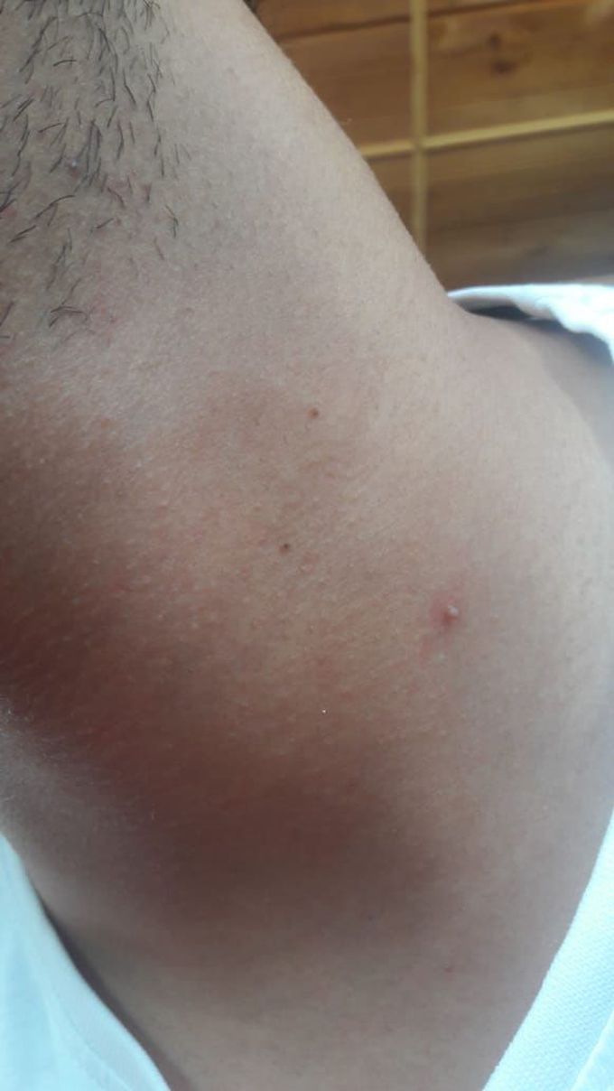 This guy is observing some sudden appearence of small cyst like things on his neck, some are red and large and some small