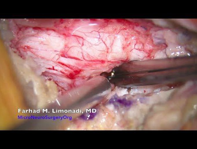 Spine Surgery: Surgical removal of a herniated disk resulting in leg weakness