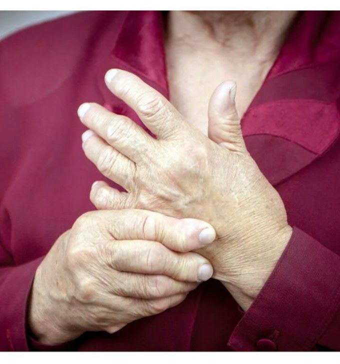 Rheumatoid Arthritis (RA)