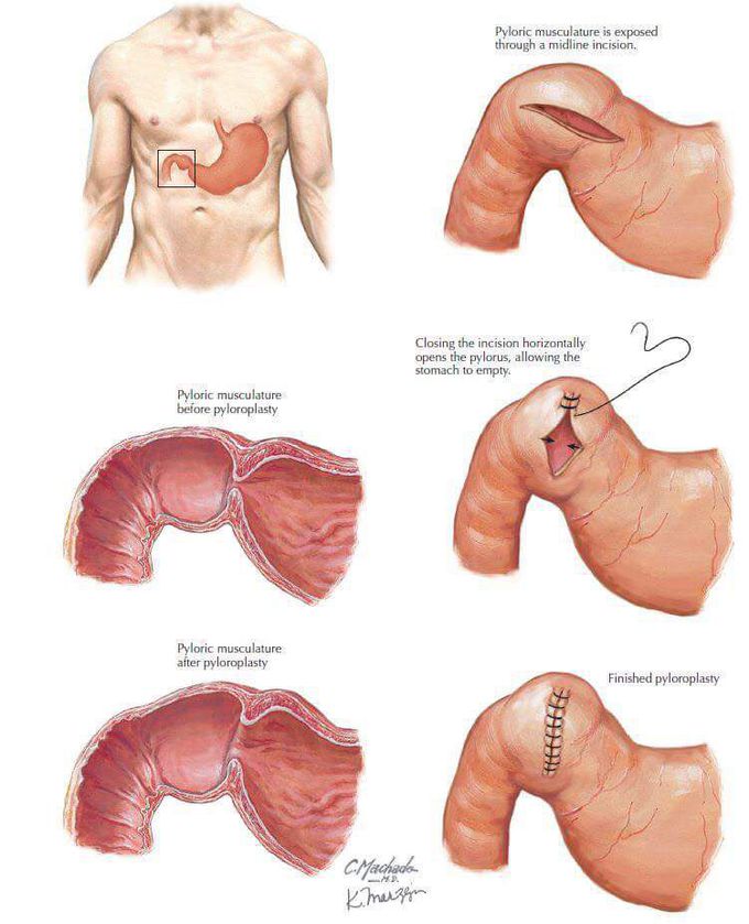 Pyloroplasty Construction.