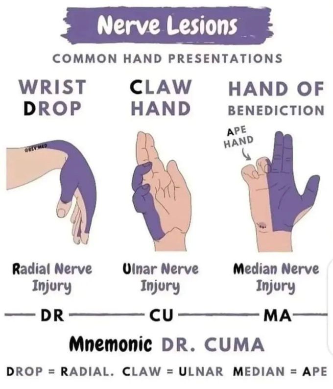 Nerve Lesions