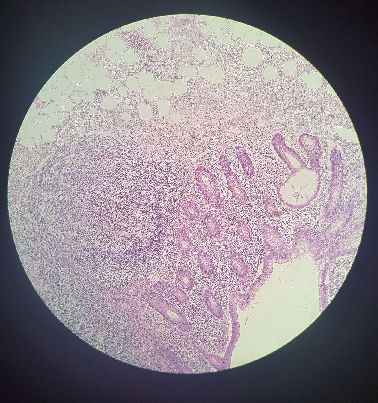 Appendix Histology Labeled Qiao's Pathology: Infarcted Appendix