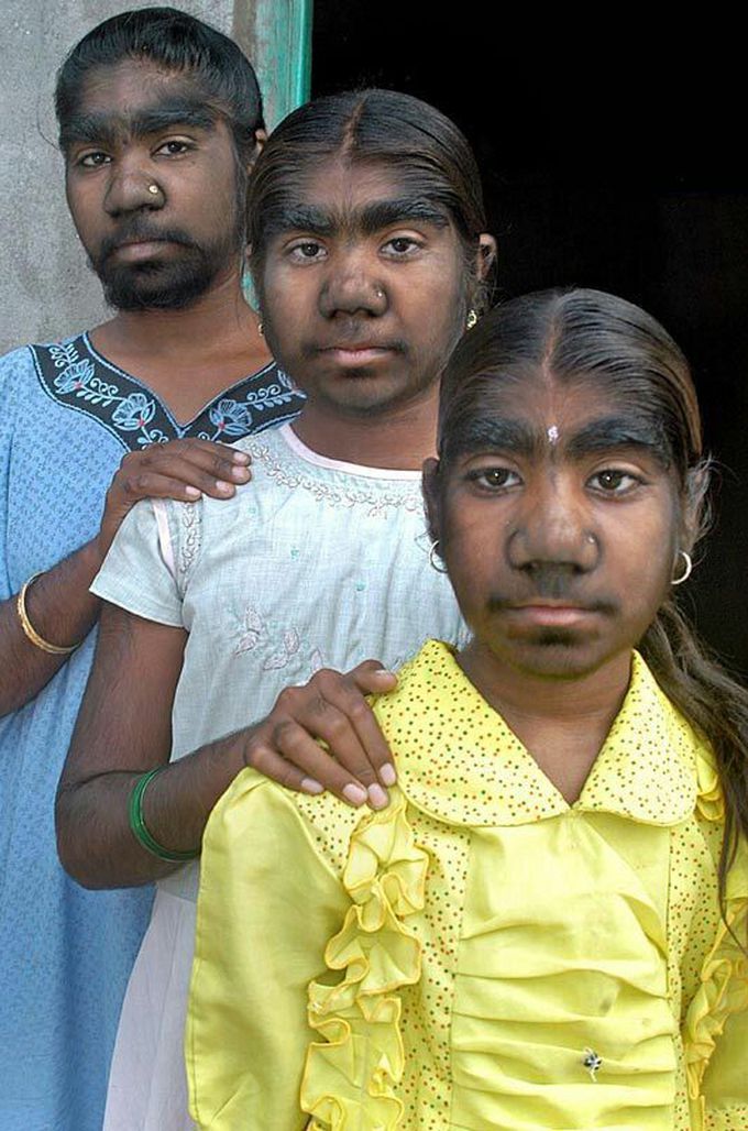 Werewolf Syndrome Rare Genitical Mutation