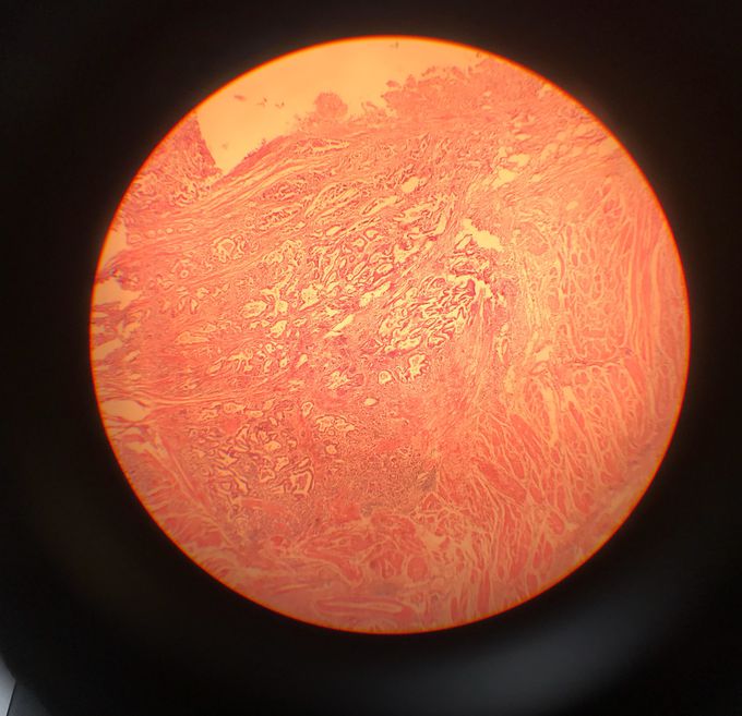 Gastric Adenocarcinoma