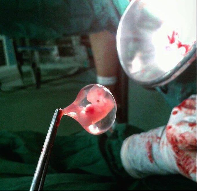 Little Embryo in Amniotic Sac